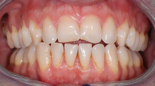 denti prima della applicazione faccette