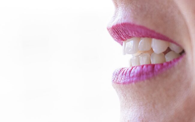 sbiancamento denti