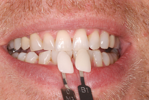trattamento sbiancamento denti - dopo