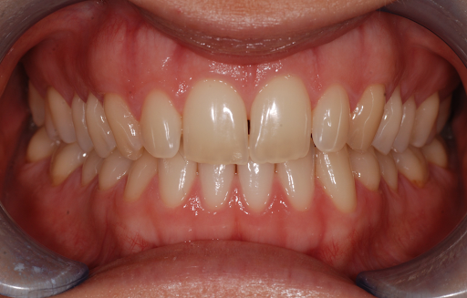 trattamento sbiancamento denti - prima