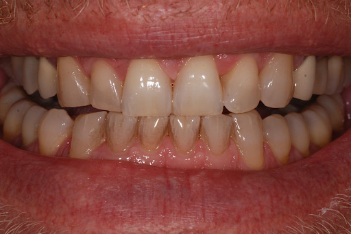 trattamento sbiancamento denti - prima
