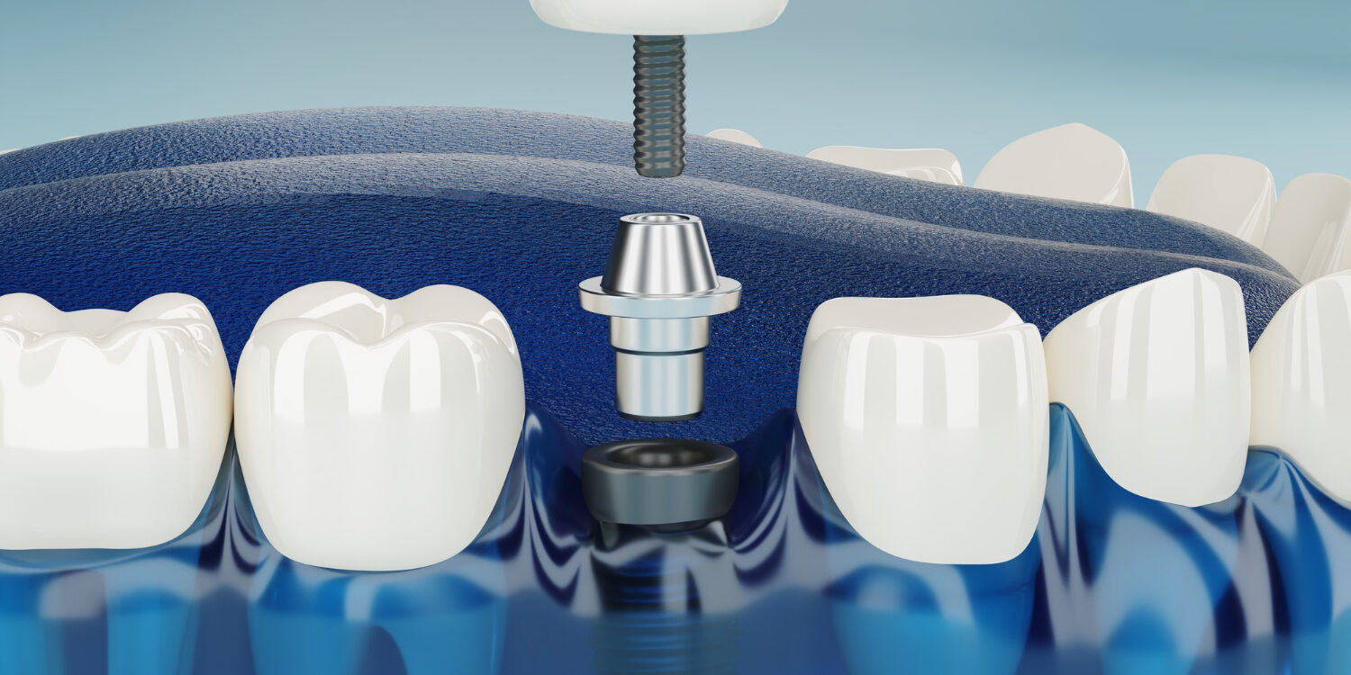 impianto carico dentale belluno | studio dentistico da ronch