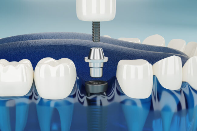 impianto carico dentale belluno | studio dentistico da ronch