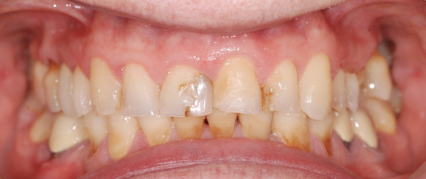 problema estetico denti frontali superiori